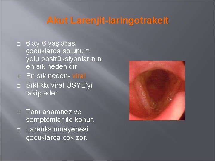 Akut Larenjit-laringotrakeit 6 ay-6 yaş arası çocuklarda solunum yolu obstrüksiyonlarının en sık nedenidir En