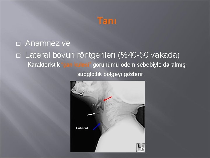 Tanı Anamnez ve Lateral boyun röntgenleri (%40 -50 vakada) Karakteristik “çan kulesi” görünümü ödem