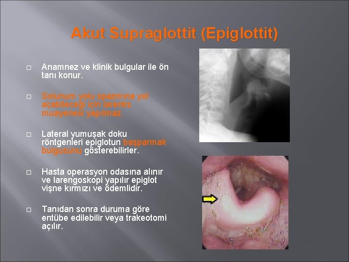 Akut Supraglottit (Epiglottit) Anamnez ve klinik bulgular ile ön tanı konur. Solunum yolu spazmına