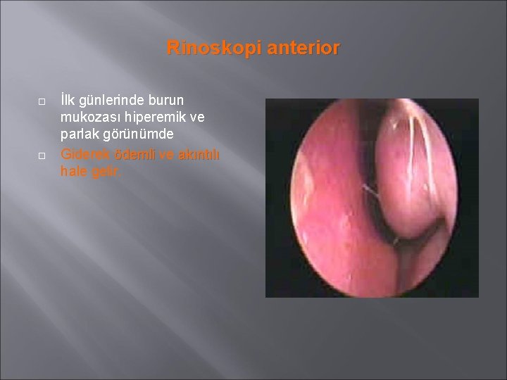 Rinoskopi anterior İlk günlerinde burun mukozası hiperemik ve parlak görünümde Giderek ödemli ve akıntılı