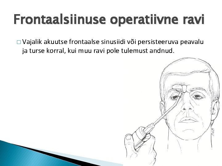 Frontaalsiinuse operatiivne ravi � Vajalik akuutse frontaalse sinusiidi või persisteeruva peavalu ja turse korral,