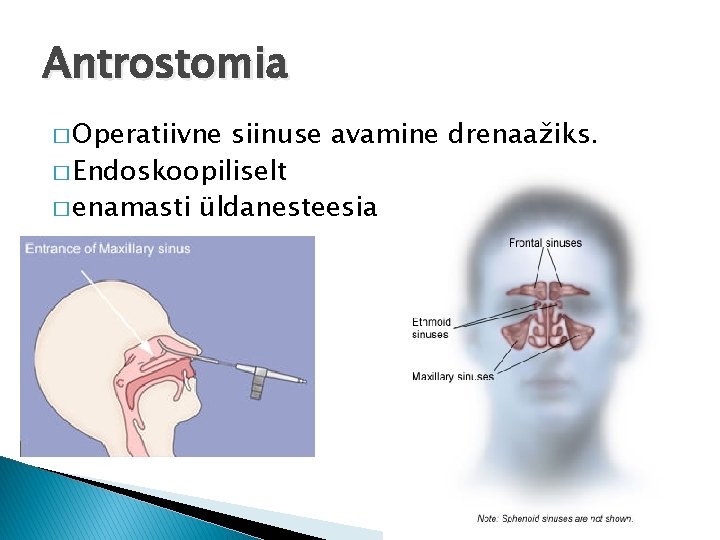 Antrostomia � Operatiivne siinuse avamine drenaažiks. � Endoskoopiliselt � enamasti üldanesteesia 