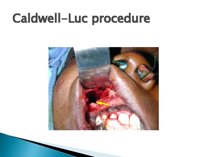 Caldwell-Luc procedure 
