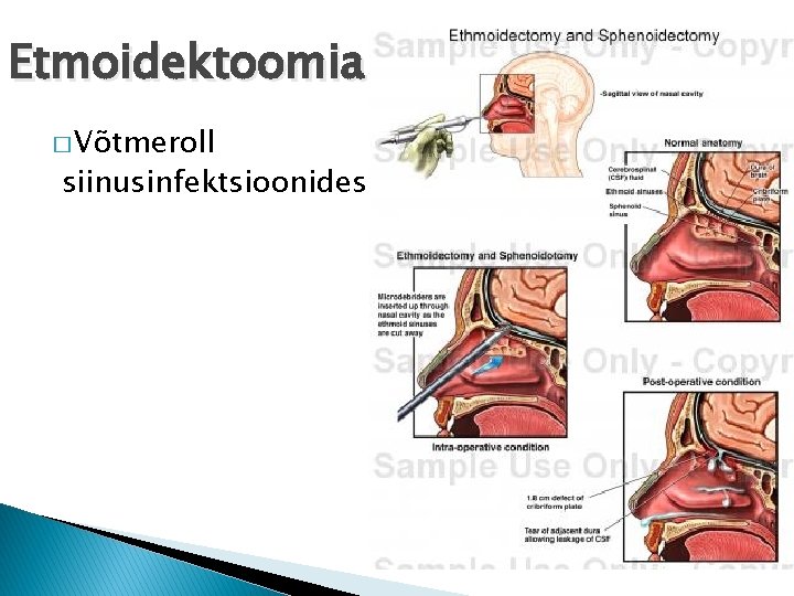 Etmoidektoomia � Võtmeroll siinusinfektsioonides 