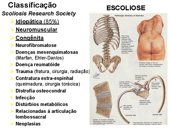Classificação Scoliosis Research Society Ø Idiopática (85%) Ø Neuromuscular Ø Congênita Ø Neurofibromatose Ø