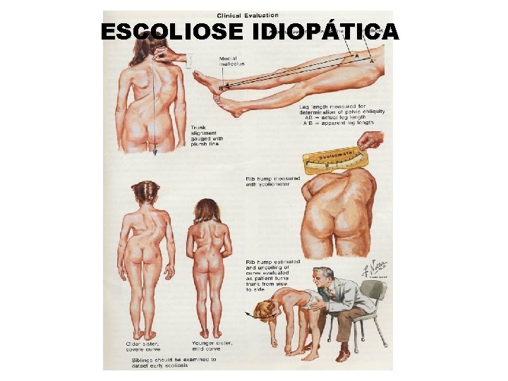 ESCOLIOSE IDIOPÁTICA 