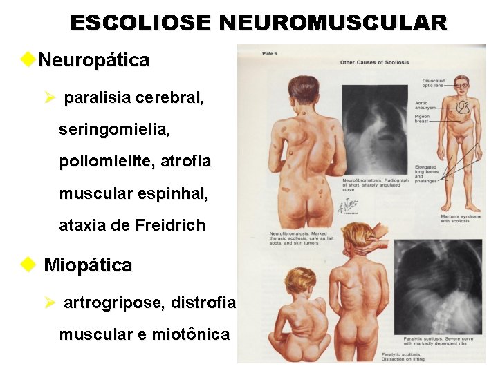 ESCOLIOSE NEUROMUSCULAR u. Neuropática Ø paralisia cerebral, seringomielia, poliomielite, atrofia muscular espinhal, ataxia de