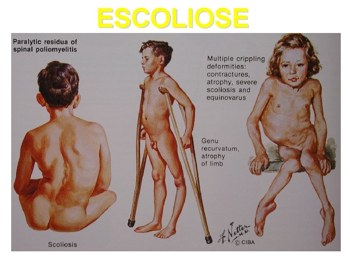 ESCOLIOSE 