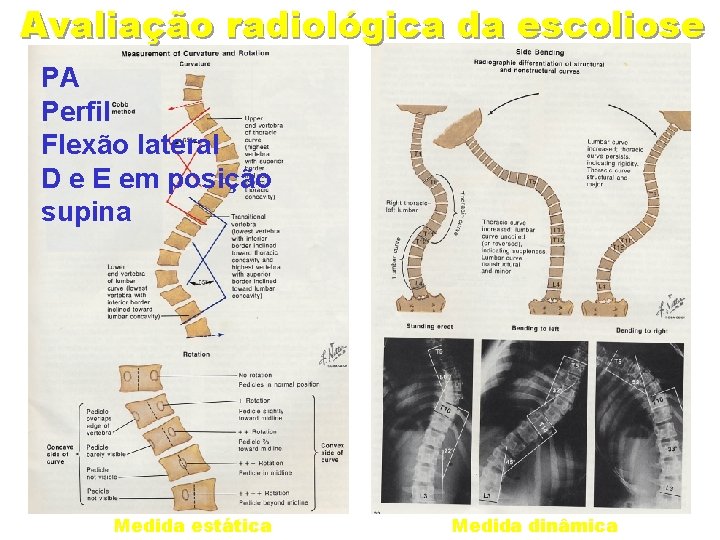 Avaliação radiológica da escoliose PA Perfil Flexão lateral D e E em posição supina