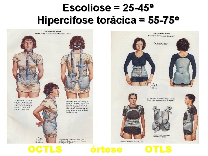 Escoliose = 25 -45 Hipercifose torácica = 55 -75 OCTLS órtese OTLS 