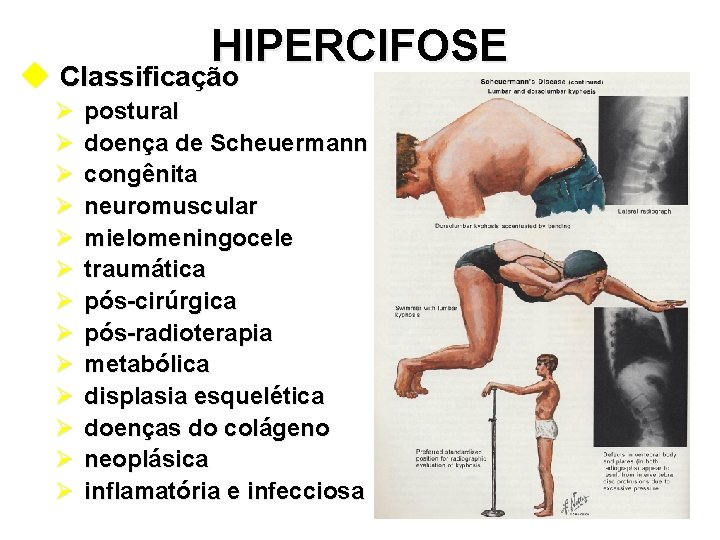 HIPERCIFOSE u Classificação Ø Ø Ø Ø postural doença de Scheuermann congênita neuromuscular mielomeningocele