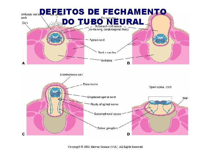 DEFEITOS DE FECHAMENTO DO TUBO NEURAL 