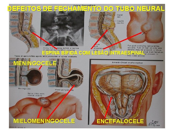 DEFEITOS DE FECHAMENTO DO TUBO NEURAL ESPINA BÍFIDA COM LESÃO INTRAESPINAL MENINGOCELE MIELOMENINGOCELE ENCEFALOCELE