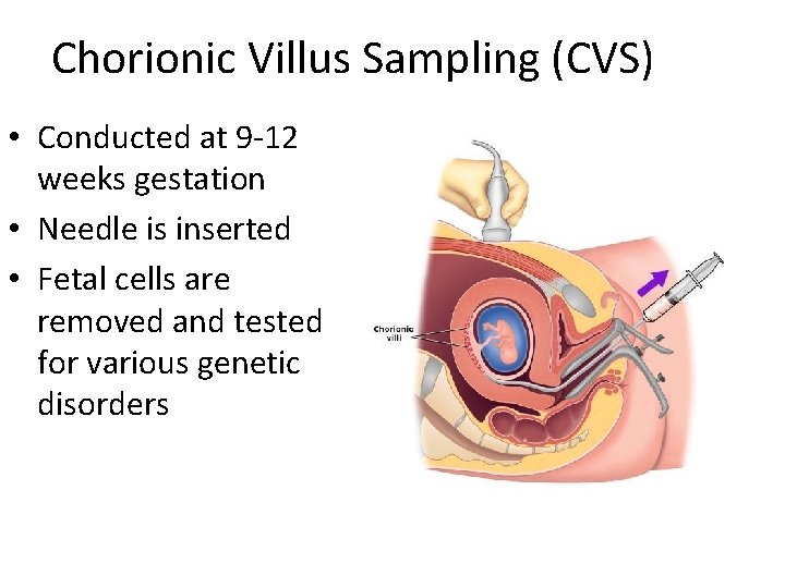 Chorionic Villus Sampling (CVS) • Conducted at 9 -12 weeks gestation • Needle is