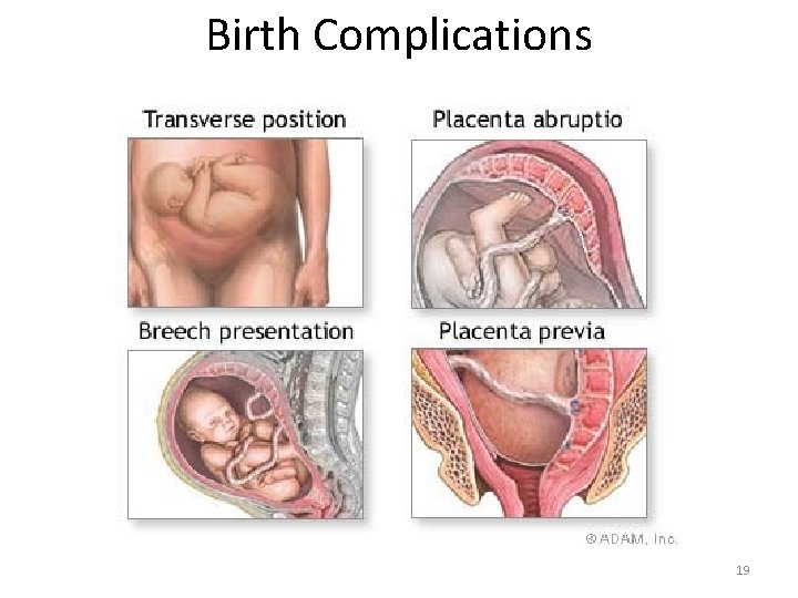 Birth Complications 19 