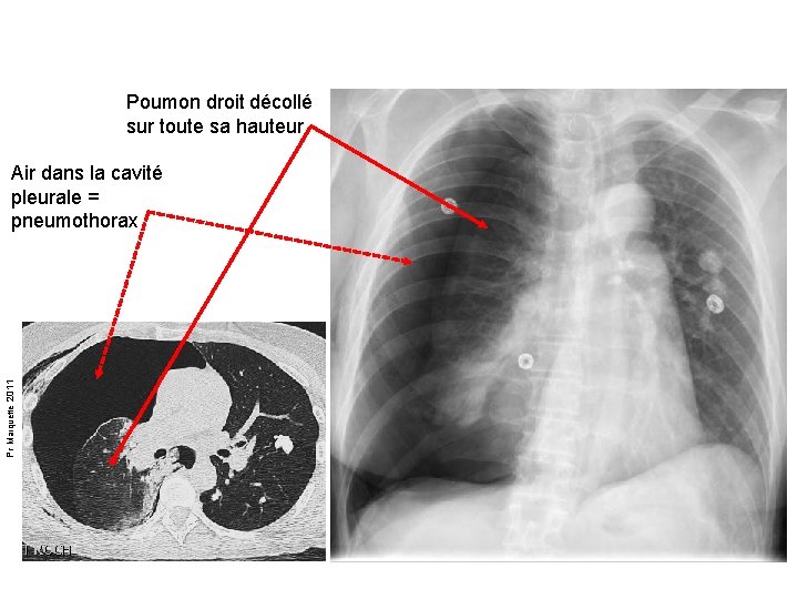 Poumon droit décollé sur toute sa hauteur Pr Marquette 2011 Air dans la cavité
