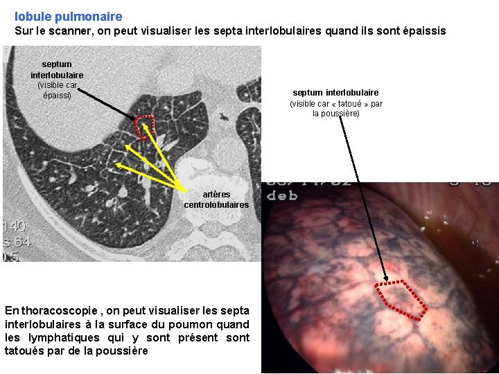 lobule pulmonaire Sur le scanner, scanner on peut visualiser les septa interlobulaires quand ils