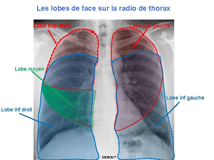 Les lobes de face sur la radio de thorax Lobe sup droit Lobe sup