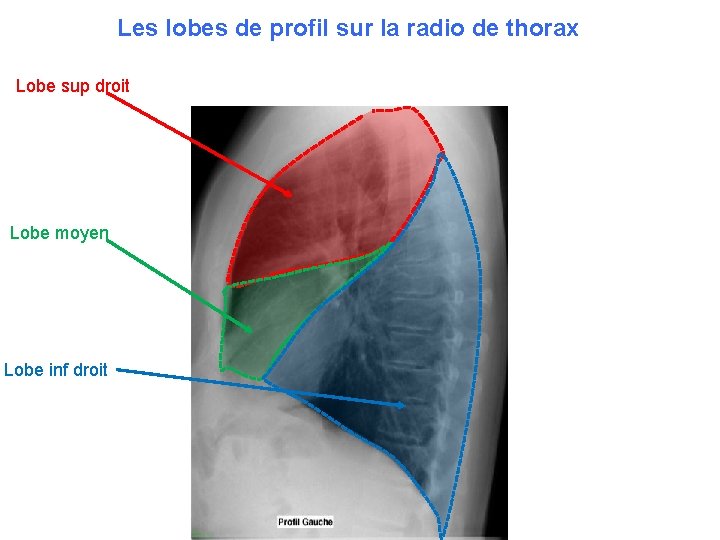 Les lobes de profil sur la radio de thorax Lobe sup droit Lobe moyen