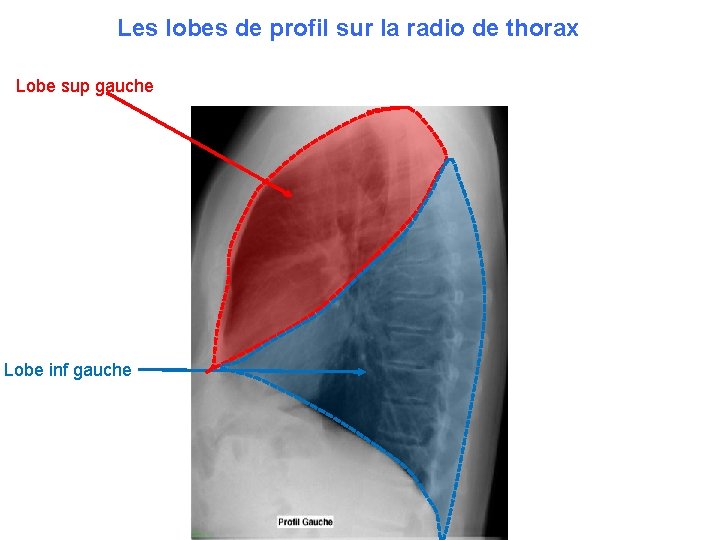 Les lobes de profil sur la radio de thorax Lobe sup gauche Lobe inf
