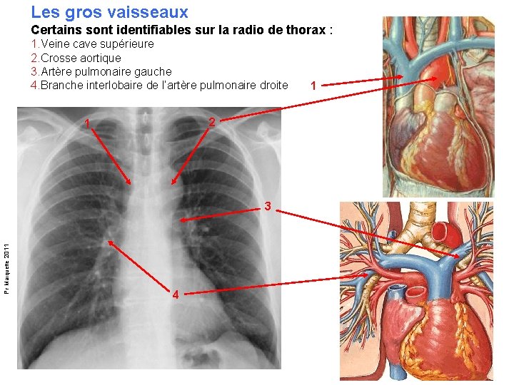 Les gros vaisseaux Certains sont identifiables sur la radio de thorax : 1. Veine