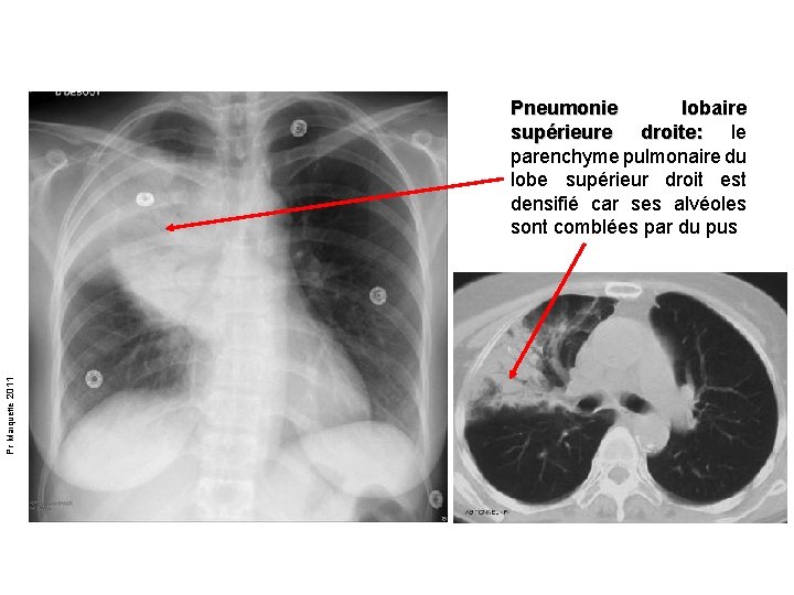 Pr Marquette 2011 Pneumonie lobaire supérieure droite: le parenchyme pulmonaire du lobe supérieur droit