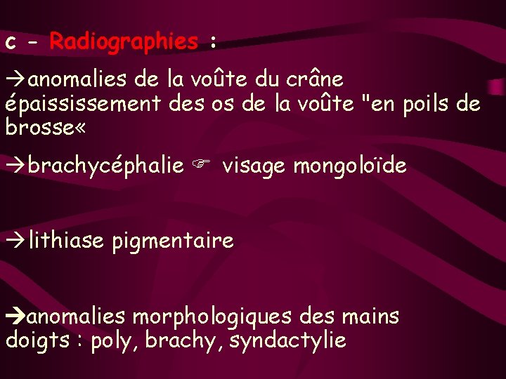 c - Radiographies : anomalies de la voûte du crâne épaississement des os de