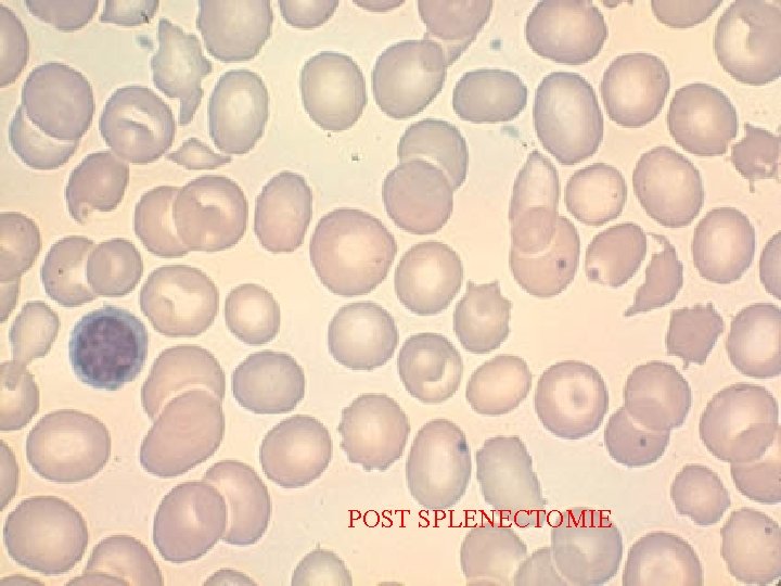 POST SPLENECTOMIE 