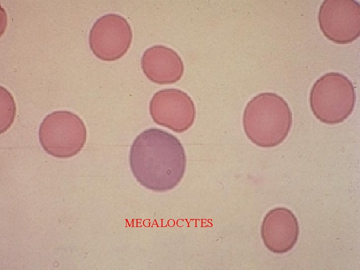 MEGALOCYTES 
