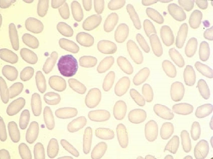 ELLIPTOCYTES 