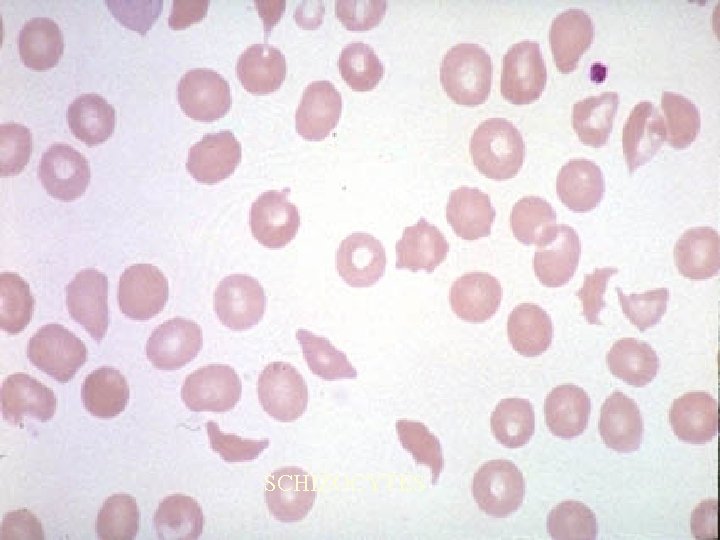 SCHIZOCYTES 