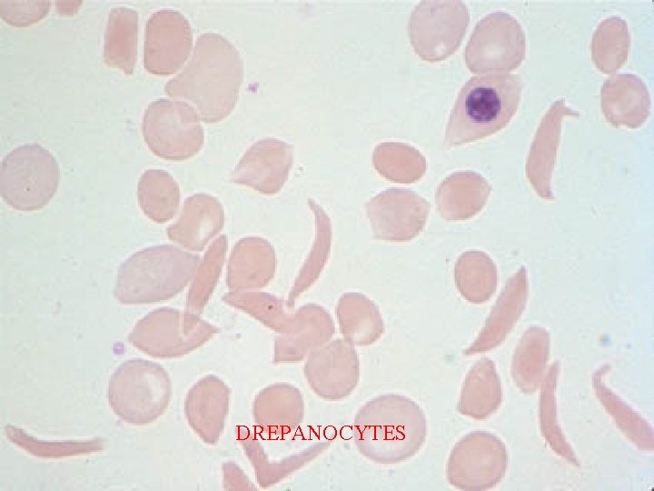 DREPANOCYTES 