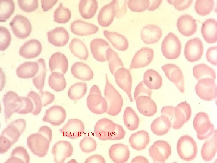 DACRYOCYTES 
