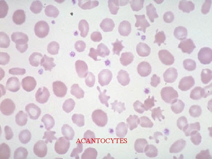 ACANTOCYTES 