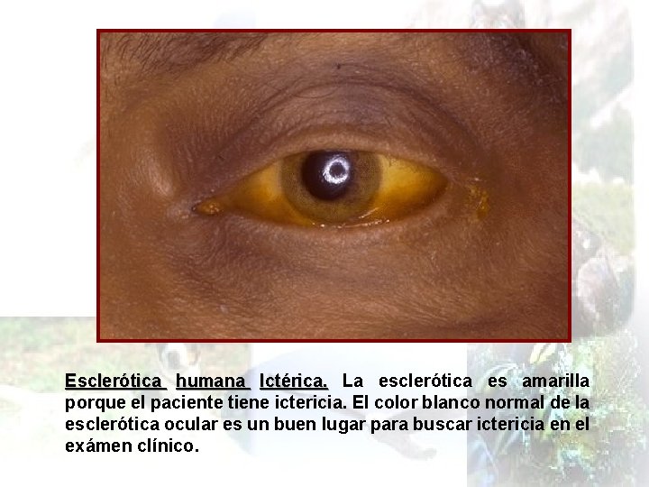 Esclerótica humana Ictérica. La esclerótica es amarilla porque el paciente tiene ictericia. El color