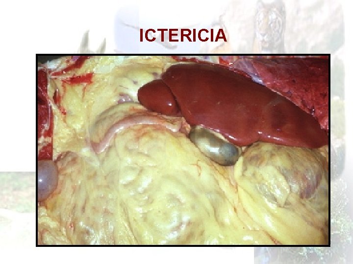 ICTERICIA 