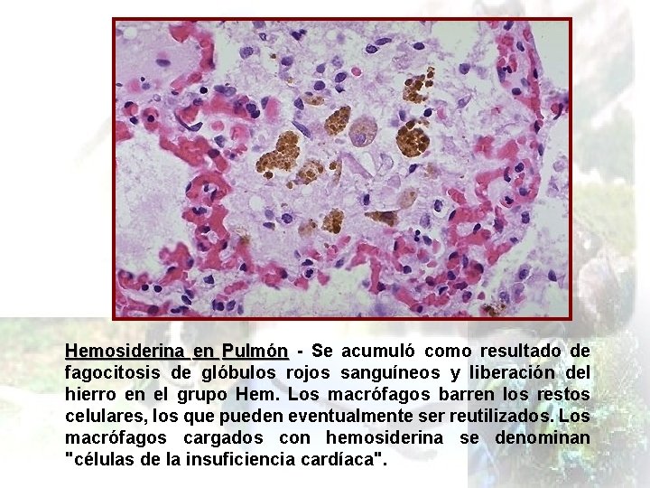 Hemosiderina en Pulmón - Se acumuló como resultado de fagocitosis de glóbulos rojos sanguíneos