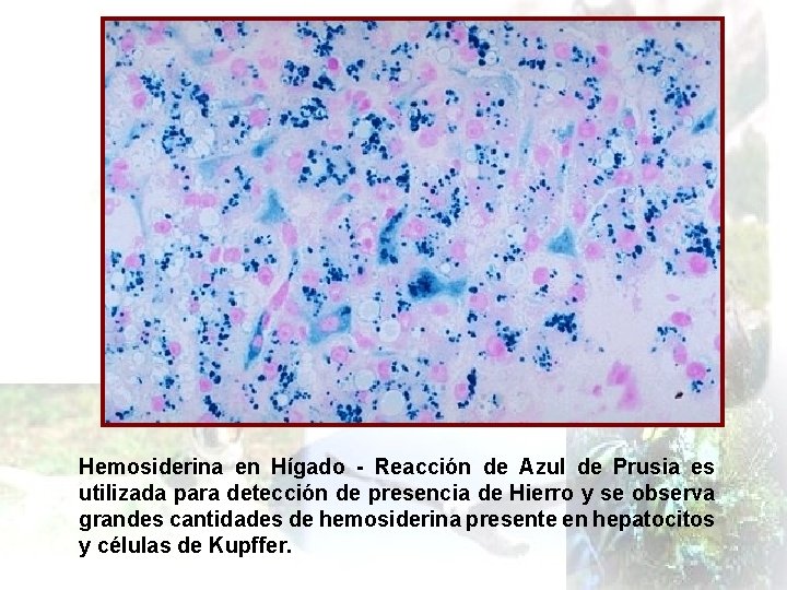 Hemosiderina en Hígado - Reacción de Azul de Prusia es utilizada para detección de
