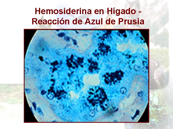 Hemosiderina en Hígado Reacción de Azul de Prusia 