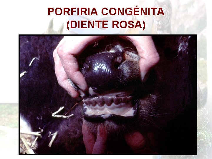 PORFIRIA CONGÉNITA (DIENTE ROSA) 