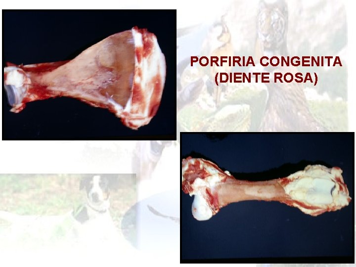 PORFIRIA CONGENITA (DIENTE ROSA) 