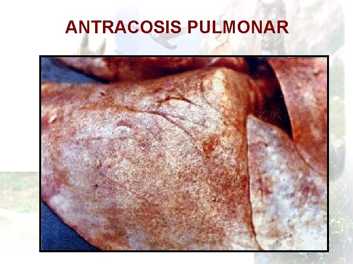 ANTRACOSIS PULMONAR 