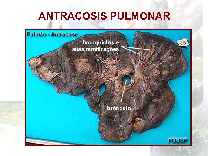 ANTRACOSIS PULMONAR 