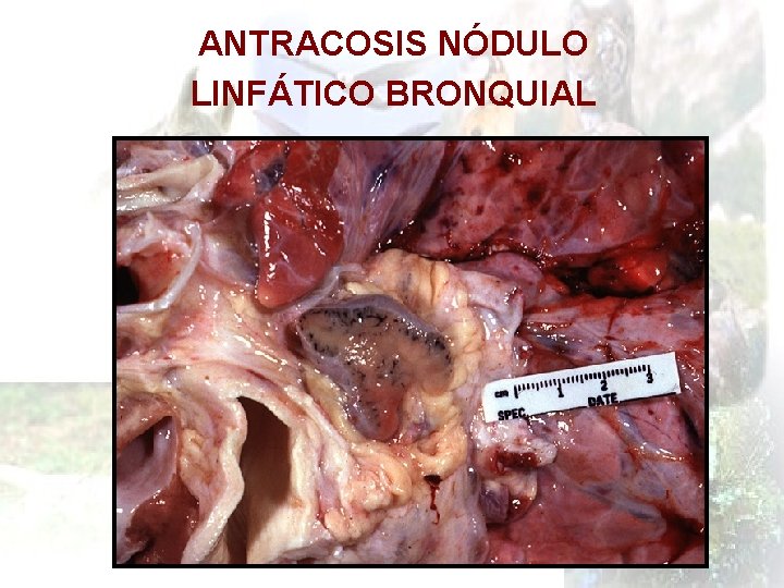 ANTRACOSIS NÓDULO LINFÁTICO BRONQUIAL 