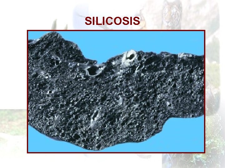 SILICOSIS 