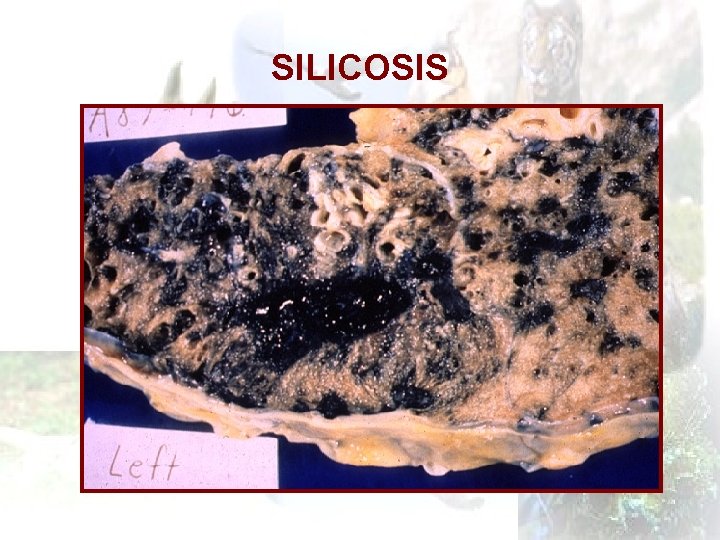 SILICOSIS 