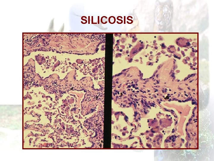 SILICOSIS 