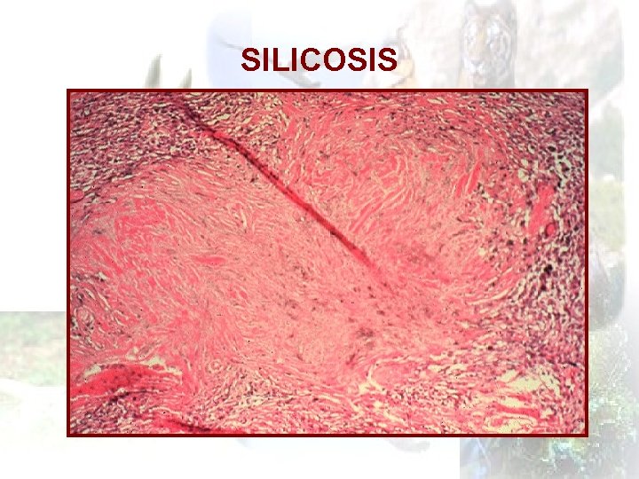 SILICOSIS 