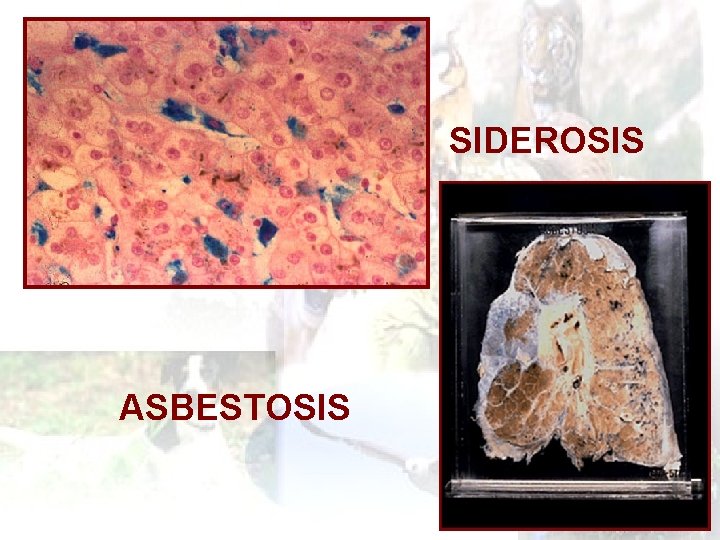 SIDEROSIS ASBESTOSIS 