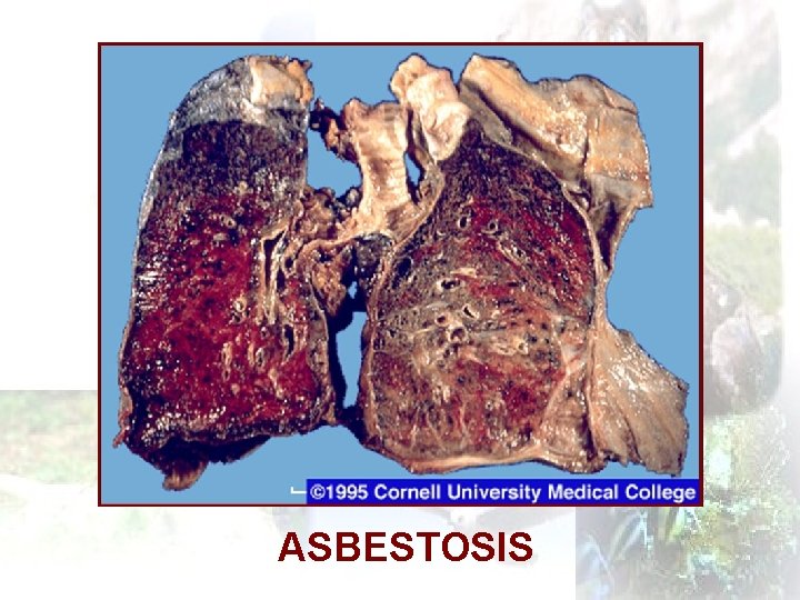 ASBESTOSIS 